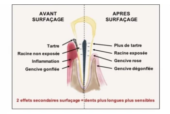 denteka le surfac age radiculaire.webp