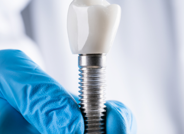 Les 5 questions les plus fréquentes sur les implants dentaires